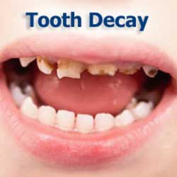 Child Tooth Decay