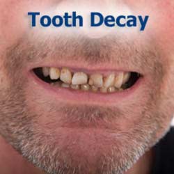 Tooth decay in child's mouth
