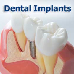 Implants