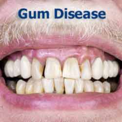 Gum Disease