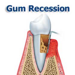 Gum Recession