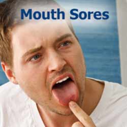 Mouth Sores
