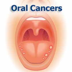 Oral Cancers