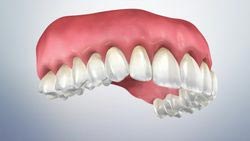 Gingival Recession