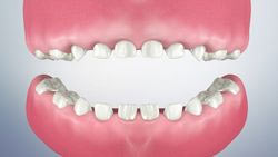 Primary Teeth & Decay