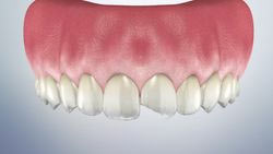 Chipped Tooth Trauma Video
