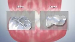 Filling vs. Crown Video