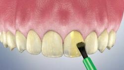 Fluoride Treatment