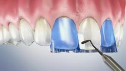 Front Tooth Filling
