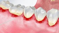 Gingivitis