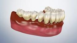 Periodontitis