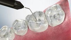 Pit & Fissure Sealants Video