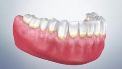 prophylaxis