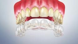 Whitening Treatment