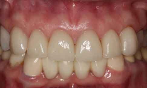 Actual Smile after Smile Design Apex Dental Group Smile Design Teeth After Smile Design Apex