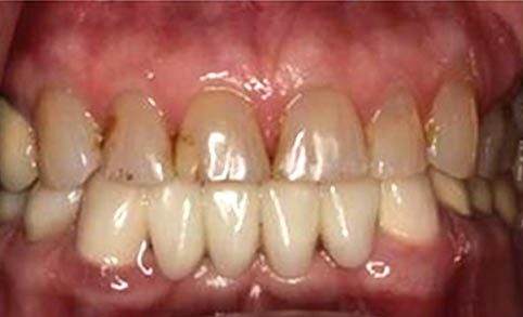 Actual Smile before Smile Design Apex Dental Group Actual Smile before Smile Design Apex Dental Group