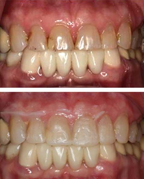 Apex Smile Design Diagnostic Trial – Before and Visualize After Apex Smile Design Diagnostic Trial - Before and Visualize After