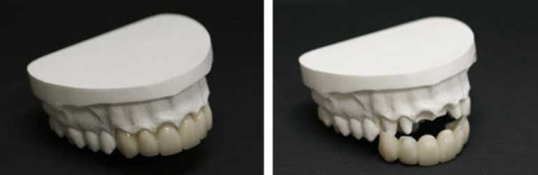 Bridges shown on dental molds – Apex Bridges on plaster molds at Apex Dental Group in Apex NC