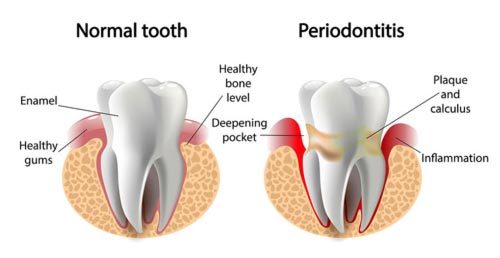 Gum Disease is treatable at Apex Dental Group in Wake County NC Gum disease chart showing healthy vs gum disease