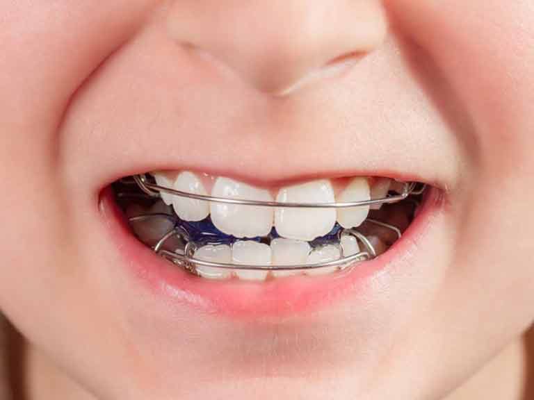 Orthodontic appliance in child’s mouth Orthodontic appliance in child's mouth at Apex Dental Group
