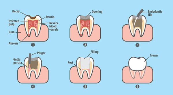 Steps to complete a root canal by Dr. J. Kitzmiller in Apex, NC Steps to complete a root canal, illustrated